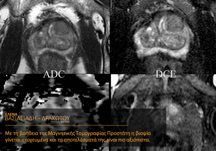 Πολυπαραμετρική-Μαγνητική Τομογραφία Προστάτη